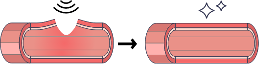 Folixレーザーの仕組み01